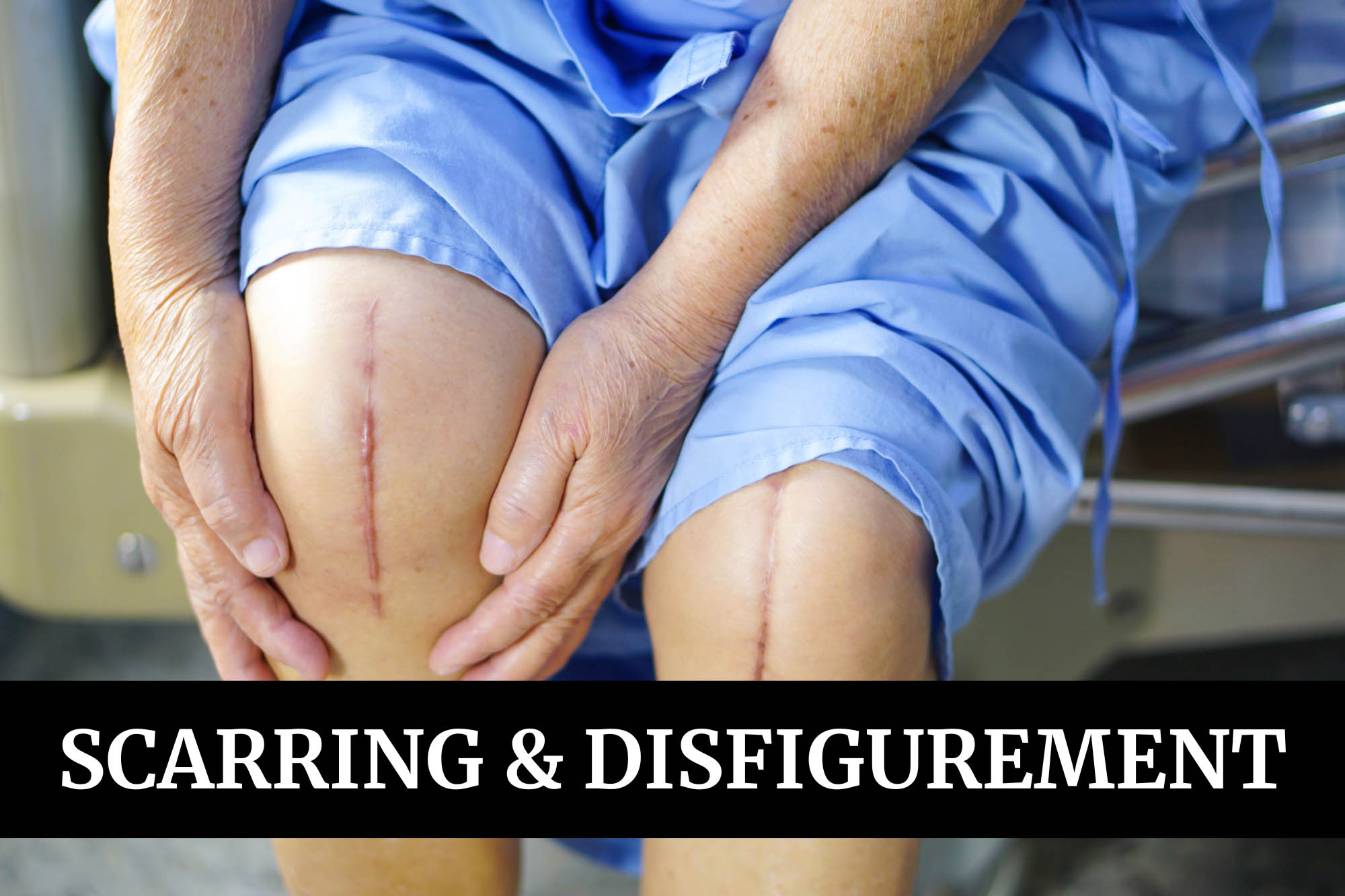 Scarring & Disfigurement - Rooney Law